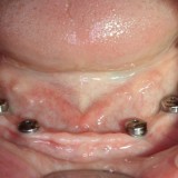 Apatiniame žandikaulyje šeši dantų implantai