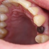 Implantas prieškrūminio danties srityje