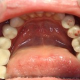 Po protezavimo atstayti krūminiai dantys